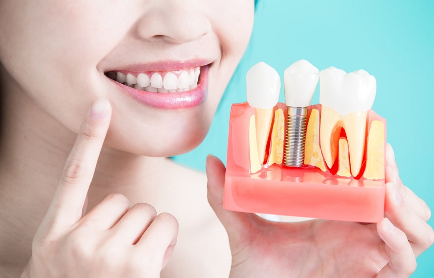 dental implant