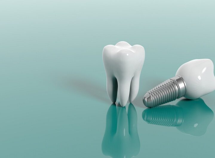 Dental implants