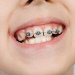 Braces for Children