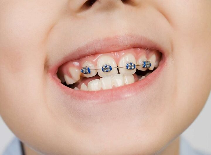 Braces for Children