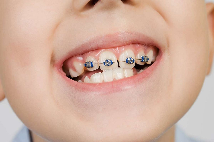 Braces for Children