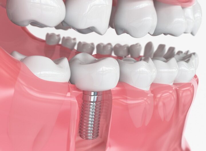 Dental Implants