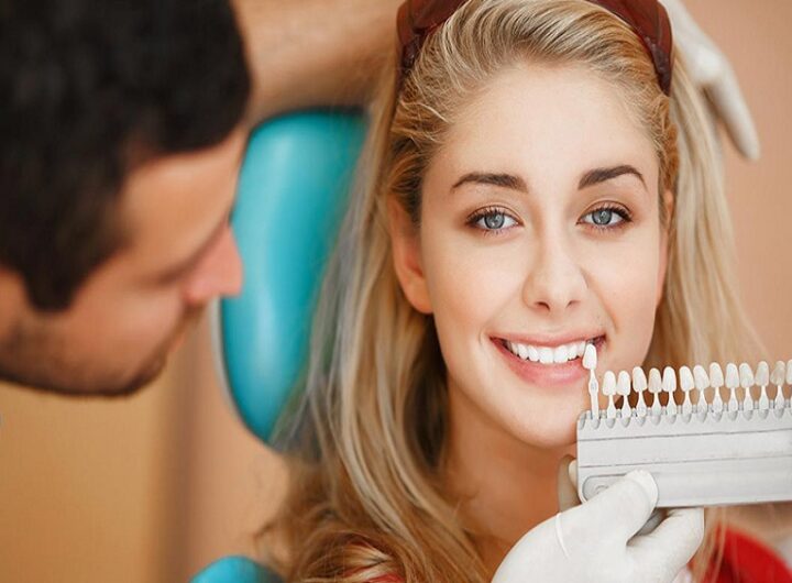 Dental Veneers in Houston